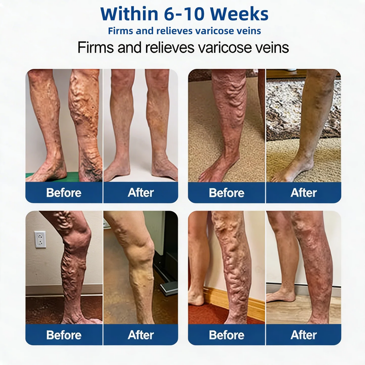 Alcuras® Vein Contour Microneedle Patch – 7-Day Visible Results for Varicose Veins
